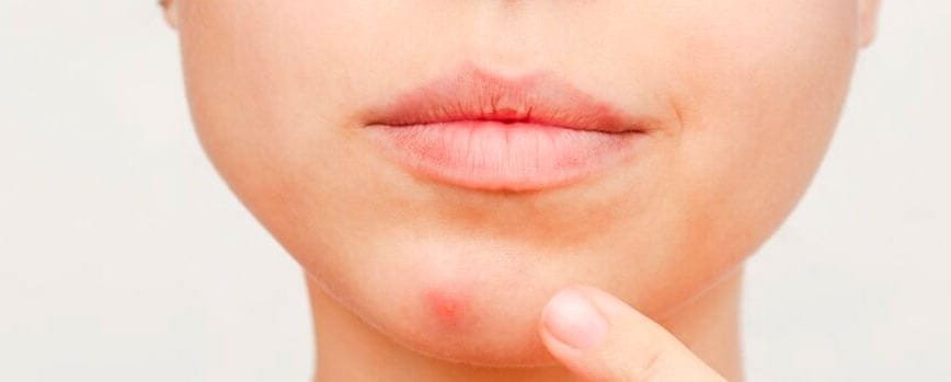 Fotografía frontal de una mujer con un grano en la barbilla, señalándolo con el dedo, sobre un fondo blanco, granos en la cara, imperfecciones faciales, remedios para los granos, cuidado de la pieltipos de acne y sus caracteristicas por que salen durante la regla