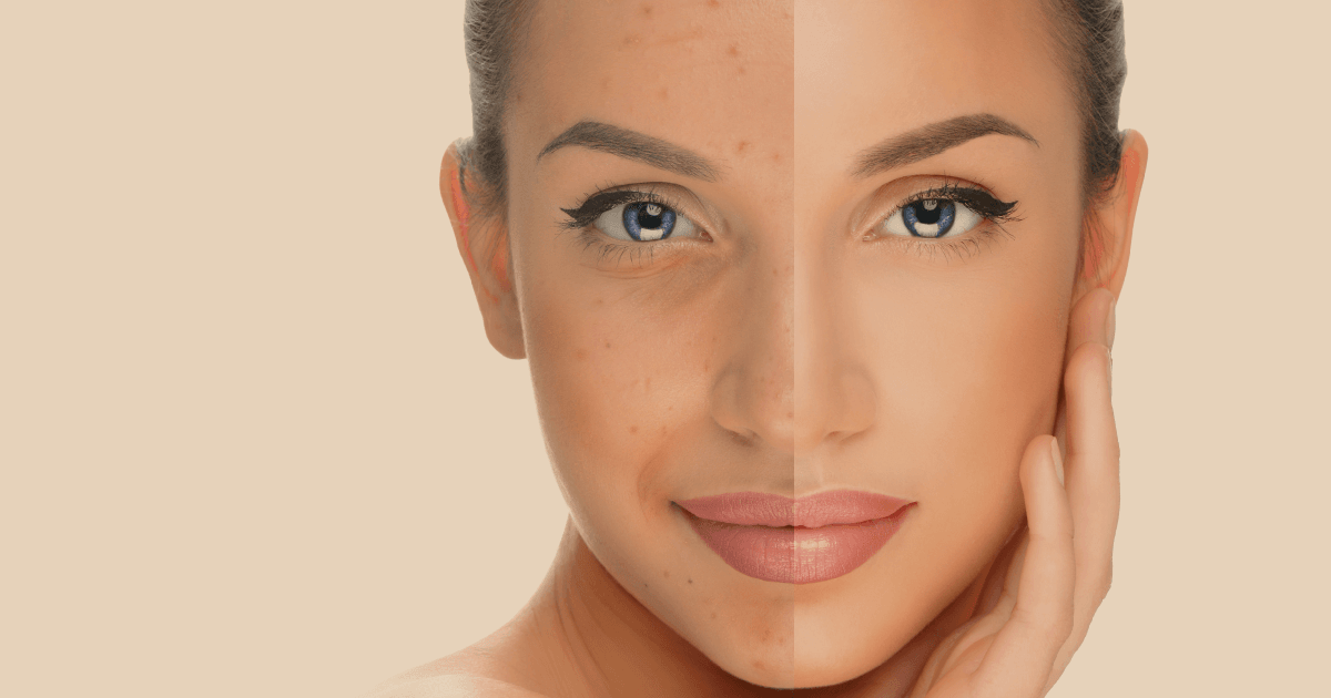 Rostro de una mujer dividido visualmente en dos mitades para mostrar un antes y después del uso de productos cosméticos o tratamientos para la piel. El lado izquierdo muestra una piel con pecas, tono desigual y ligeras imperfecciones, mientras que el lado derecho presenta una piel visiblemente más uniforme, suave y luminosa, reflejando los resultados de una rutina de cuidado facial efectiva.