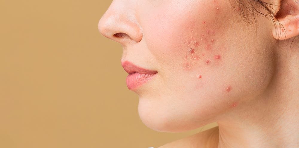 Primer plano del rostro de una mujer con brote severo de acné inflamatorio en la mejilla. La piel presenta múltiples granos rojos, pústulas y comedones, principalmente en la zona de las mejillas y la mandíbula. La imagen refleja un caso de acné activo, posiblemente hormonal o relacionado con desequilibrios cutáneos. Ideal para contenidos informativos sobre tratamientos dermatológicos, tipos de acné, rutinas especializadas para piel con imperfecciones y consejos de cuidado personal.
